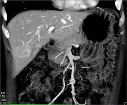 Hepatoma - CTisus CT Scan