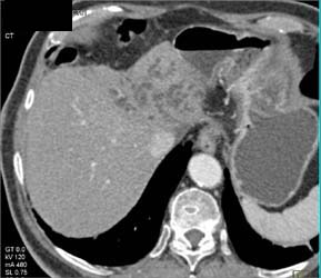 Cholangiocarcinoma - CTisus CT Scan