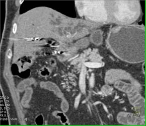 Cholangiocarcinoma - CTisus CT Scan