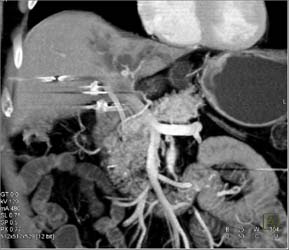 Cholangiocarcinoma - CTisus CT Scan