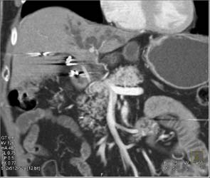 Cholangiocarcinoma - CTisus CT Scan