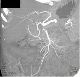 Cholangiocarcinoma - CTisus CT Scan