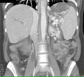 Cavernous Transformation of the Portal Vein (CTPV) With Varices and Collaterals - CTisus CT Scan