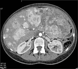 Metastatic Islet Cell Tumor of the Pancreas to the Liver - CTisus CT Scan