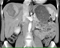 Spontaneous Bleed in Hepatic Adenoma - CTisus CT Scan