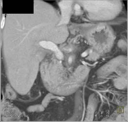 Gallbladder Cancer - CTisus CT Scan