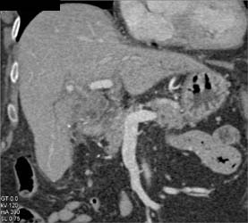 Gallbladder Cancer - CTisus CT Scan