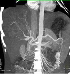 Fibrolamellar Hepatoma With Neovascularity - CTisus CT Scan