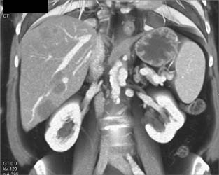 Liver Metastases From Soft Tissue Sarcoma - CTisus CT Scan