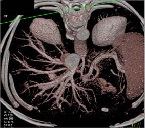 Normal Liver Venous Anatomy - CTisus CT Scan