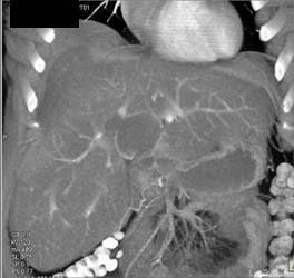 Pseudolesion of Liver - CTisus CT Scan