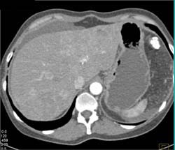 Metastatic Adenocarcinoma to the Liver - CTisus CT Scan