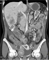 Small Bowel Adenocarcinoma - CTisus CT Scan