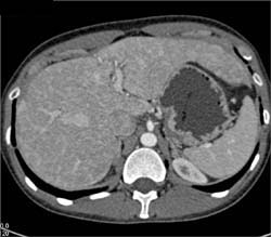 Textural Changes in Liver - CTisus CT Scan