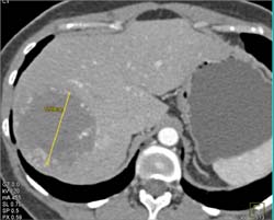 Giant Hemangioma - CTisus CT Scan