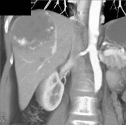 Giant Hemangioma - CTisus CT Scan