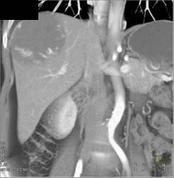 Giant Hemangioma - CTisus CT Scan