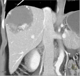 Giant Hemangioma - CTisus CT Scan