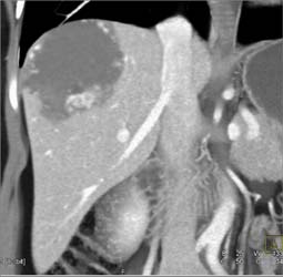 Giant Hemangioma - CTisus CT Scan