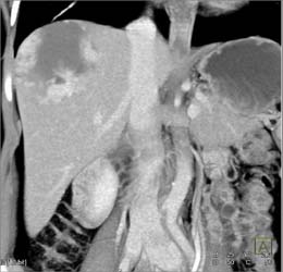 Giant Hemangioma - CTisus CT Scan