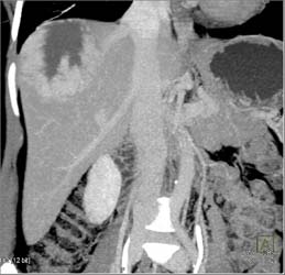 Giant Hemangioma - CTisus CT Scan