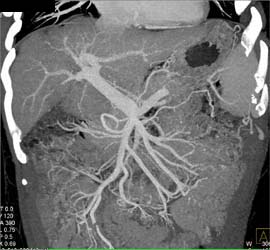 Normal Portal Vein and Superior Mesenteric Vein (SMV) - CTisus CT Scan