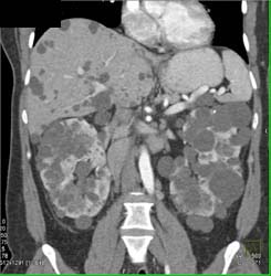 Pck-pcld - CTisus CT Scan