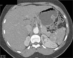 Regenerating Nodes in the Spleen - CTisus CT Scan