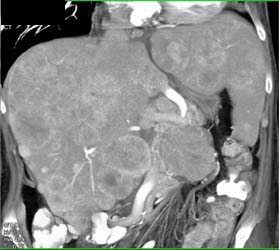 Liver Metastases From A Pancreatic Primary - CTisus CT Scan