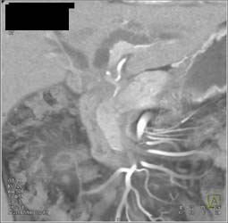 Cholangiocarcinoma - CTisus CT Scan