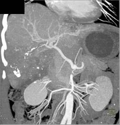 Hepatoma - CTisus CT Scan