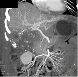 Hepatoma - CTisus CT Scan