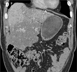 Hepatoma - CTisus CT Scan