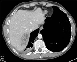 Liver Metastases - CTisus CT Scan