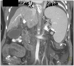 Cirrhosis With Partial Portal Vein Thrombosis (PVT) - CTisus CT Scan