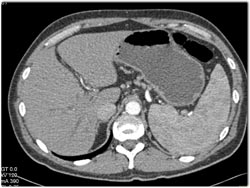 Cholangiocarcinoma Best Seen on Late Phase Images - CTisus CT Scan