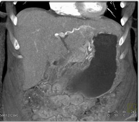 Metastatic Islet Cell Tumor With Neovascularity - CTisus CT Scan