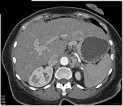 Metastatic Islet Cell Tumor - CTisus CT Scan