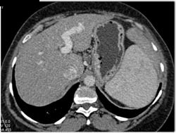 Av Fistulae Simulates A Vascular Liver Lesion - CTisus CT Scan