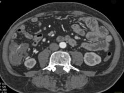 Increased Blood Flow in Ileocolic Vessels Due to Cirrhosis - CTisus CT Scan