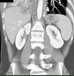 Liver Abscess Due to Colitis - CTisus CT Scan