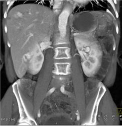 Vascular Liver Lesions - CTisus CT Scan