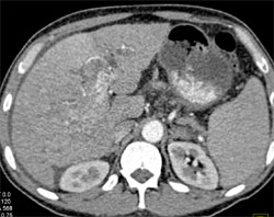 Hepatoma Invades the Portal Vein in Several Phases - CTisus CT Scan