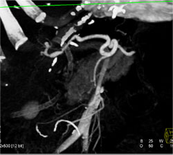 Stenosis Hepatic Artery S/P Transplant - CTisus CT Scan