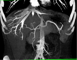 Unusual Enhancement Liver - CTisus CT Scan