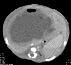 Liver Abscess - CTisus CT Scan