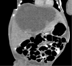 Liver Abscess - CTisus CT Scan