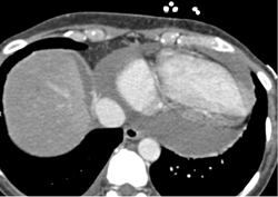 Pericardial Effusion and Right Heart Failure - CTisus CT Scan