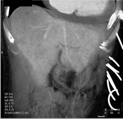 Hepatic Congestion Due to Right Heart Failure - CTisus CT Scan