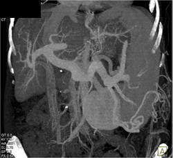 Cirrhosis W/ Varices - CTisus CT Scan